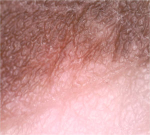 A dermatoscopia da borda da lesão mostra reduzida rede pigmentar na lesão em relação à pele normal.