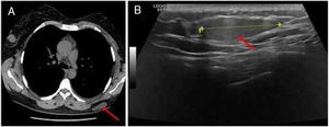 Características imagiológicas do tumor: A, Tomografia computadorizada torácica de alta resolução revelando nódulo subcutâneo hipodenso de grandes dimensões na região dorsal esquerda (seta vermelha); B, Ecografia revelando massa subcutânea bem definida, ligeiramente hiperecogênica, na região dorsal esquerda (seta vermelha).