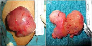 Características macroscópicas do tumor: A, Durante a ressecção cirúrgica do tumor, sob anestesia local; B, Após excisão completa, o tumor media aproximadamente 60 × 50 × 20mm, apresentava superfície externa gelatinosa e, quando secionado, revelou consistência mole e cor acastanhada.