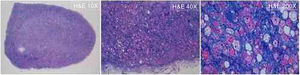Características microscópicas do tumor: o exame histopatológico da peça cirúrgica revelou tumor hipodérmico com cápsula fibrosa fina, constituído por adipócitos com citoplasma granular, eosinofílico, sem atipia citológica, numerosos adipócitos multivacuolados, estabelecendo o diagnóstico definitivo de hibernoma. (Hematoxilina & eosina: 10×, 40×, 200×).