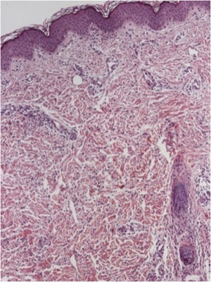 Infiltrado inflamatório linfo‐histiocitário perivascular e intersticial com alguns eosinófilos de permeio. (Hematoxilina & eosina, 100×).