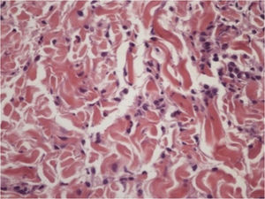 Infiltrado histiocitário intersticial com eosinófilos. (Hematoxilina & eosina, 400×).