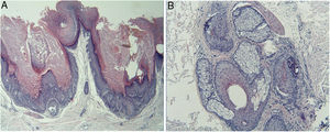 A, As invaginações apresentavam numerosas fissuras e células disceratósicas acantolíticas localizadas na epiderme inferior (Hematoxilina & eosina,100×). B, Cisto com células disceratósicas acantolíticas em um folículo piloso (Hematoxilina & eosina,200×).