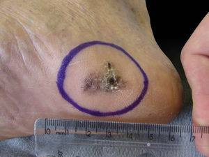 Aspecto pré‐operatório. Aspecto inicial do melanoma acral, operado com cicatrização por segunda intenção.