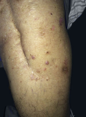 Presença de pápulas eritematosas, com brilho perláceo e placas, pouco elevadas, eritematoacastanhadas adjacentes à cicatriz cirúrgica na coxa esquerda – visão anterolateral.
