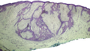 Proliferação epitelial infiltrando a derme, com anastomoses em aspecto cordonal, acompanhado de desmoplasia circunjacente (hematoxilina & eosina, ×4).