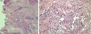 A, Microfotografia da derme mostra o acometimento superficial e profundo da derme e do tecido celular subcutâneo (Hematoxilina & eosina, 200×). B, Microfotografia da derme média mostra denso infiltrado linfo‐histiocitário com neutrófilos (Hematoxilina & eosina, 400×).