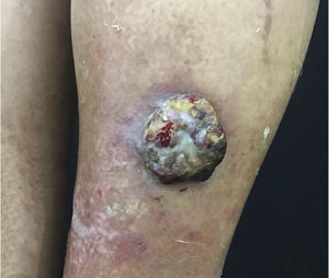 Nódulo eritemato‐violáceo, de crescimento rápido, com 3cm na perna direita.