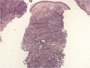 Tumor dérmico, com arranjo trabecular, composto por pequenas células azuis com citoplasma escasso e núcleo compacto (Hematoxilina & eosina, 20×).