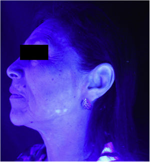 Vitiligo na hemiface esquerda (exame com luz de Wood).