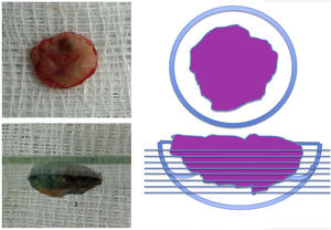 Imagem do material enucleado e demonstração da forma como os cortes foram feitos (cortes horizontais no sentido da superfície à profundidade da peça).