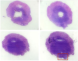 Cortes histológicos horizontais do material enucleado (Hematoxilina & eosina, 20×). Imagem superior esquerda corresponde ao corte superficial e imagem inferior direita ao corte mais profundo. Destaque do comprometimento da margem lateral (retângulo vermelho).