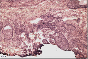 Visão microscópica do corte histológico horizontal com margem comprometida (Hematoxilina & eosina, 100×).