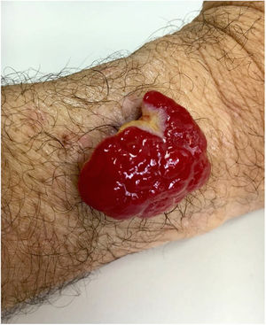 Nódulo eritematoso exofítico, 4,5 cm no maior diâmetro, no antebraço esquerdo.