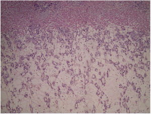 Aspecto geral da histopatologia: proliferação de pequenos vasos (Hematoxilina & eosina, 40×).