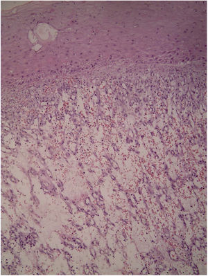 Histologia: intenso infiltrado inflamatório de neutrófilos com deposição de fibrila (Hematoxilina & eosina, 100×).