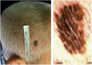 Imagem clínica e dermatoscópica do melanoacantoma. A, Imagem clínica: placa de 9mm, assimétrica, marrom escura, bem demarcada na região parietal direita. B, Imagem dermatoscópica com luz polarizada: presença de pontos distribuídos irregularmente na lesão (setas vermelhas) e “dedos gordos” (setas amarelas).