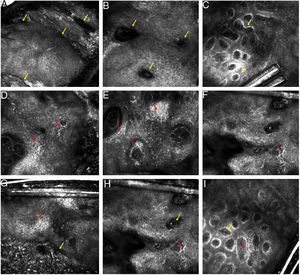 A‐I, Imagens da microscopia confocal do melanoacantoma. A‐C, Achados sugestivos de CS. A, Ao nível epidérmico, padrão em favo de mel típico e projeções epidérmicas (setas amarelas); B, Invaginações preenchidas por queratina (setas amarelas); C, Ao nível da JDE, papilas dérmicas bem demarcadas, redondas e polimorfas (setas amarelas). D‐E, Achados suspeitos para melanoma. D, Ao nível epidérmico, padrão em favo de mel típico e células pagetoides dendríticas (setas vermelhas); E e F, Ao nível da JDE, infiltração de células dendríticas em torno e entre as papilas dérmicas (setas vermelhas). G‐I, Achados presentes tanto na CS (setas amarelas) quanto no melanoma (setas vermelhas).