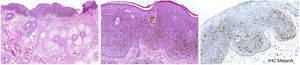Análise histopatológica e imuno‐histoquímica do melanoacantoma. A, Epiderme hiperplásica, hiperceratose e acantose intensa. B, Permeados aos ceratinócitos, observam‐se melanócitos dendríticos presentes em toda a lesão. C, Imuno‐histoquímica mostrando densidade aumentada de melanócitos. (A e B, Coloração Hematoxilina & eosina; C, coloração Melan A; aumento original: A, 40×; B–C, 400×).