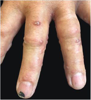Lesões vesiculares múltiplas acometem o antebraço esquerdo e a mão esquerda.