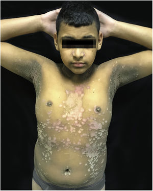 Placas eritematosas, verrucosas, distribuídas no tronco e no abdome.