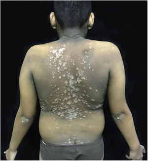 Placas eritematosas, verrucosas, distribuídas no dorso.