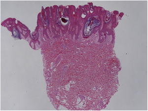 Cortes de pele exibem superfície papilomatosa, recoberta por camada córnea lamelar, com numerosos esporos de Malassezia sp. (Hematoxilina & eosina, 40×).