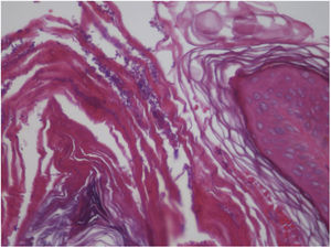 Esporos de Malassezia sp. no estrato córneo (Hematoxilina & eosina, 400×).