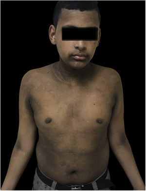 Resultado do tratamento, com melhora do aspecto das lesões.