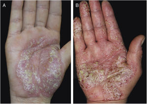 Quadro clínico: pustulose palmoplantar das mãos. A, paciente com mutação heterozigótica c.140A>G/p.Asn47Ser; B, paciente sem mutação de IL36RN.