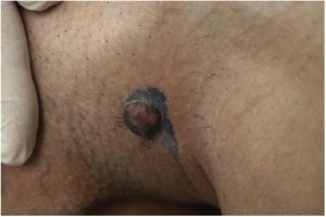 Mácula melanocítica de cor azul‐preta, com tumor rosado sobreposto.