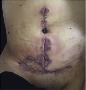 PG ulcerativo após abdominoplastia.