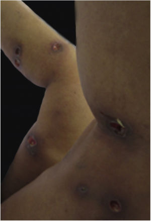 Múltiplas úlceras de PG em locais de injeções para escleroterapia de varizes.