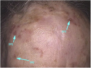 Ceratoses actínicas faciais não pigmentadas: múltiplas pápulas pequenas e placas eritematosas com escamas esbranquiçadas na superfície e graus variados de hiperceratose.