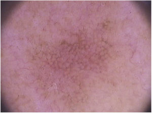 Dermatoscopia de ceratose actínica pigmentada facial (Fotofinder®, 20×): uma pseudorrede acastanhada que poupa os óstios foliculares é observada, além de escamas na superfície e pseudorrede vascular subjacente.