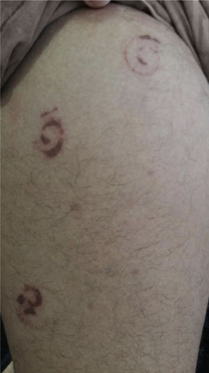 Mancha eritematoacastanhada, em forma de espiral, na coxa direita.