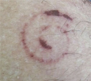 Detalhe da lesão.