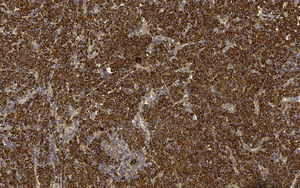 Estudos imuno‐histoquímicos evidenciaram expressão monoclonal de cadeias leves de imunoglobulina kappa (Imunoperoxidase; 200×).