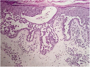Acantólise suprabasal extensa, com formação bolhosa intraepidérmica e queratinócitos com aspecto típico em “muro desmoronado” (Hematoxilina & eosina, 40×).