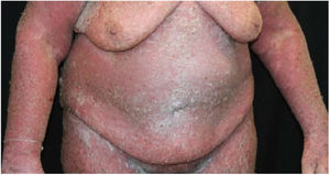 Eritrodermia esfoliativa. Áreas intertriginosas com intenso eritema e tendência à maceração.