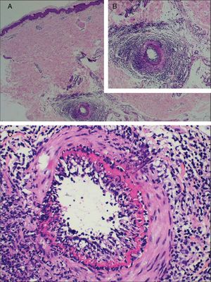 Achados histológicos típicos da arterite macular linfocítica. A, Artéria dermo‐hipodérmica circundada por infiltrado linfocítico denso que permeia sua parede; B, Maior ampliação da vista do vaso anterior; C, Um anel hialino concêntrico é mostrado (Hematoxilina & eosina, 400×).