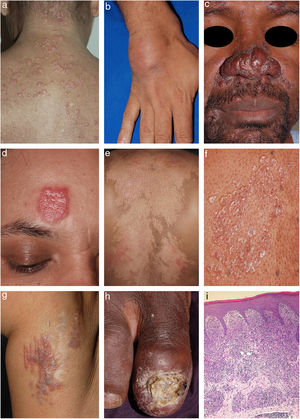 Exemplos clínicos de sarcoidose cutânea: A, Forma papulosa; B, Forma subcutânea; C, Lúpus pérnio; D, Angiolupoide, E, Forma hipocromiante; F, Lesões liquenoides; G, Lesões em cicatriz antiga; H, Infiltração periungueal com osteíte e onicodistrofia; I, Granulomas compostos predominantemente por histiócitos epitelioides (Hematoxilina & eosina, 40×).