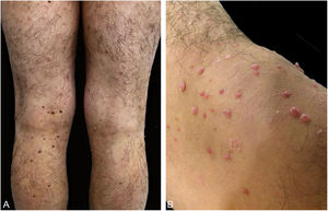 A‐B, pápulas rosadas e cor da pele, com aparência verrucosa e base séssil.