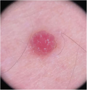 Dermatoscopia: lesões vascularizadas homogêneas e rosadas, com pequenas escamas na superfície.