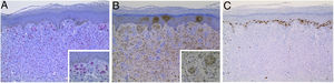 Estudo imuno‐histoquímico. A, SOX10 com um padrão de coloração nuclear em melanócitos. B, proteína S100 foi positiva. C, proteína S100 foi positiva.