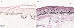 Corte histológico de cultura organoide (72 horas) de pele retroauricular (Fontana‐Masson, 400×). A, Cultura não irradiada; B, cultura irradiada com 1,524J/cm2 de UVA.