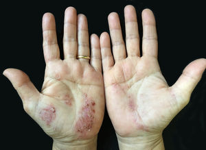 Descamação e pigmentação marrom em pele eritematosa das palmas das mãos.