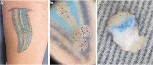A, Aspecto clínico da tatuagem com múltiplas pápulas dispostas linearmente. B, Dermatoscopia in vivo (aumento 10×) evidencia pápulas com projeções digitiformes e pontilhados vermelhos correspondentes a ectasias vasculares. C, Dermatoscopia ex vivo (aumento 20×) evidencia na porção superior a epiderme com projeções papilomatosas e pontilhados hemorrágicos e presença de pigmento na derme superficial.