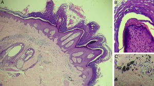 Exame histopatológico do paciente 1, (Hematoxilina & eosina). A, aumento 40×, evidencia epiderme com papilomatose, hiperceratose proeminente com paraceratose, hipergranulose, acantose e cristas epidérmicas alongadas e derme com presença de depósito extracelular de pigmento preto, compatível com pigmento exógeno. B, aumento de 200× evidencia detalhe de papilomatose. C, aumento de 200× com detalhe do acúmulo do pigmento preto na derme.