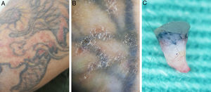 A, Aspecto clínico da tatuagem com múltiplas pápulas eritematosas discretas e dispostas difusamente, tanto sobre a tatuagem quanto na pele sã. B, Dermatoscopia in vivo (aumento 10×) evidencia detalhe das pápulas com descamação inespecífica, sem projeções digitiformes e pontilhados vermelhos. C, Dermatoscopia ex vivo (aumento 20×) evidencia na porção superior a epiderme pouco espessada e com discretas projeções papilomatosas planas, associadas à presença de pigmento na derme superficial e média.